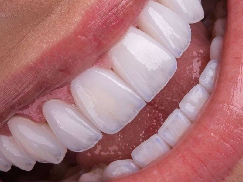 Facetas dentárias: 12 dúvidas mais frequentes antes de decidir pelo tratamento