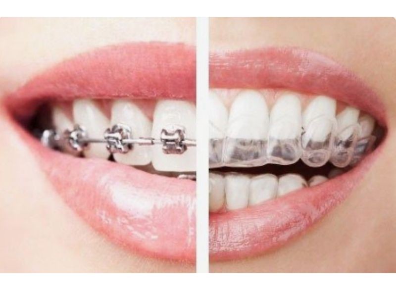 Quais são os tipos de aparelho ortodôntico (fixo, móvel, invisível) e qual escolher