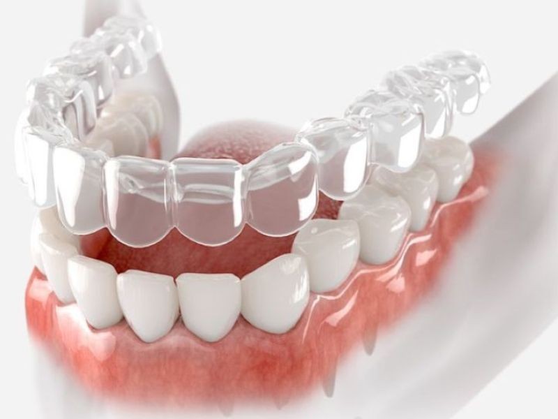 Tenho dentes tortos: posso tratar com alinhadores?