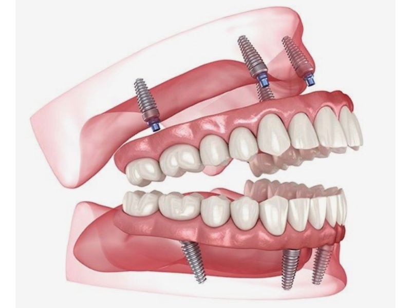Prótese protocolo: preparo pré-operatório completo para um tratamento seguro