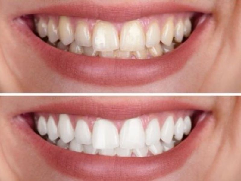 Clareamento dental: quais são os métodos mais seguros para fazer: a laser ou caseiro?