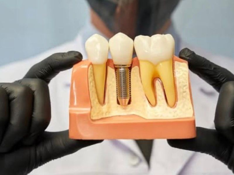 Falta osso para implante? Levantamento de seio maxilar: a solução pode estar aqui