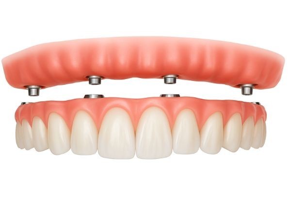 Implantes e Próteses Dentárias: Respostas às Principais Dúvidas dos Pacientes em Goiânia