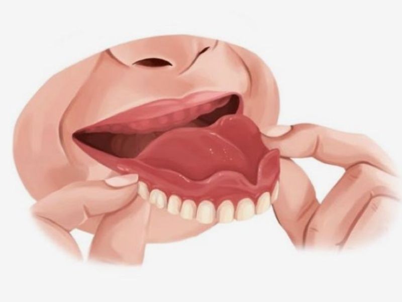 Quando é necessário trocar a prótese dentária? Sinais de alerta