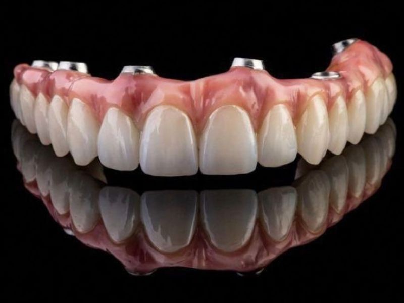 Dê adeus à dentadura: sorria sem medo com a prótese protocolo