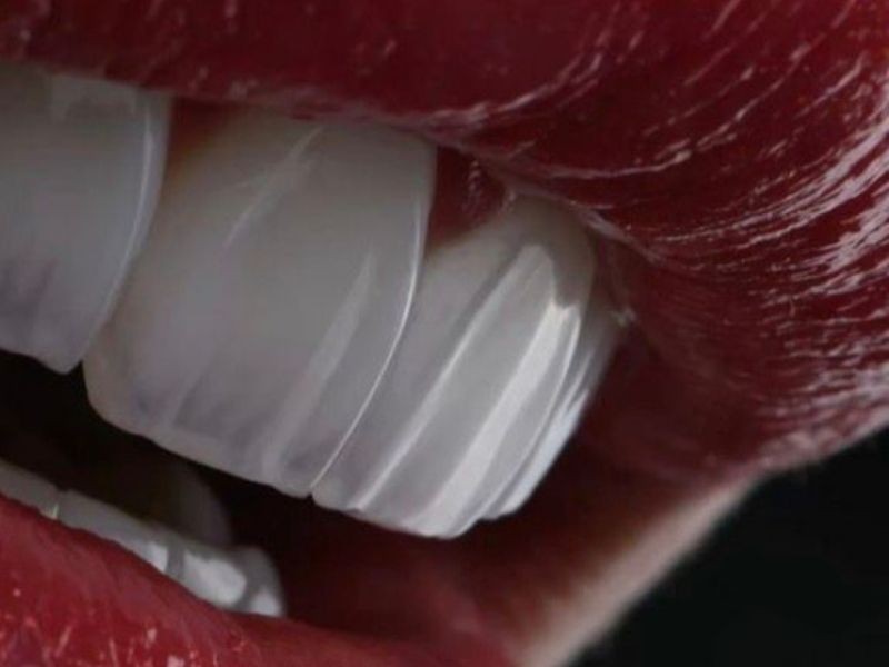 É possível remover ou substituir facetas dentárias? Mitos e verdades sobre reversibilidade