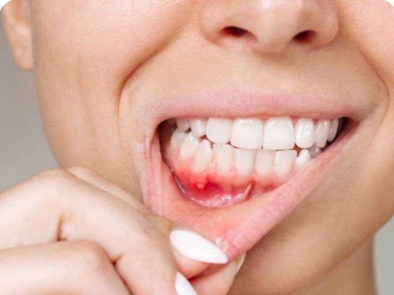 Gengivite e Periodontite: Sintomas, Causas e Tratamentos para Proteger Sua Saúde Bucal