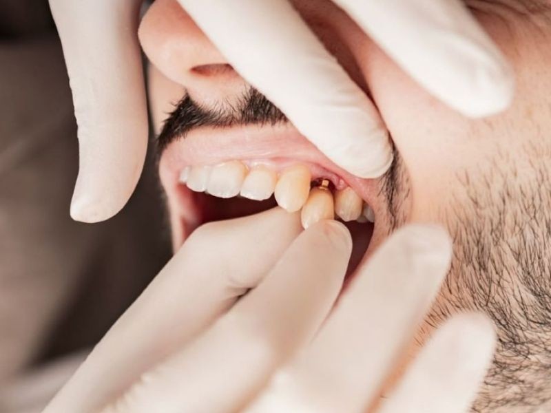 Quem sofre de bruxismo pode fazer implante dentário?
