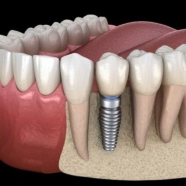 Implantes Dentários em Setor Oeste