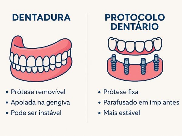 Diferenças entre Dentadura e Protocolo Dentário