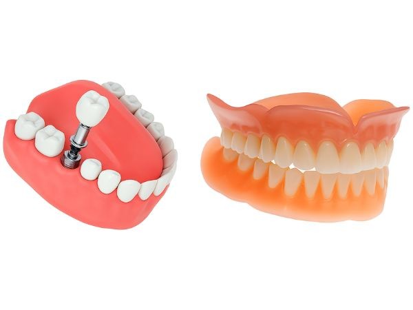 Diferenças entre Dentadura e Protocolo Dentário em Trindade